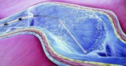 What to expect from ClariVein Treatment?