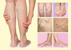 Who is at risk of vein disease?