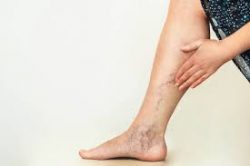 Spider Vein Treatments