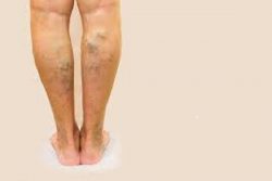 Vein & Skin Clinic: Vein Treatments