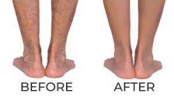 Vein Problems and Treatments