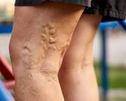How to Find the Best Vein Doctor Near Me