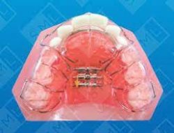 Tongue Crib Orthodontics Treatment