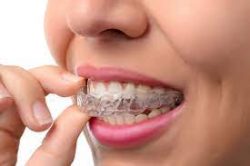 Invisalign Clear Aligners Treatment