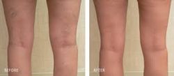 Sclerotherapy at Laser Vein Removal Center