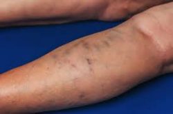 How will a vascular clinic near me diagnose vein diseases?