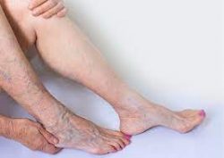 Vein Clinic Conducts Varicose Vein Treatment