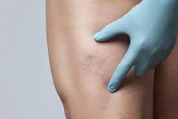 What happens during minimally invasive vein treatment in Houston?