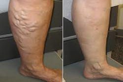 What happens during minimally invasive vein treatments?