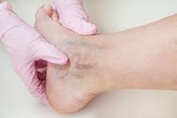 The Best Varicose Vein Doctor will use Minimally Invasive Procedures to Treat Your Varicose Veins. 