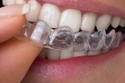 invisalign in miami fl