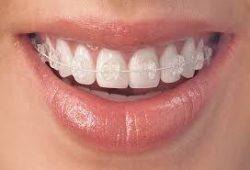 invisalign miami fl