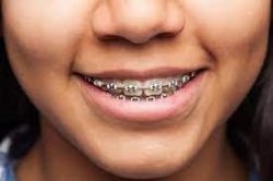 Braces For Adults Miami. Fl