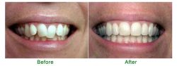 Braces Cost In Miami Florida