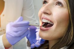 braces in miami prices