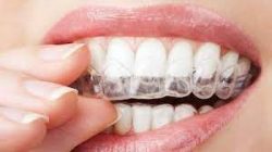 Invisalign Orthodontist Near North Miami Beach
