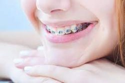 Invisalign Orthodontist Near North Miami,Fl