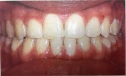 Orthodontist Near North Miami FL