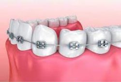 Affordable Braces North Miami