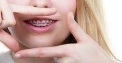 Best Orthodontist For Braces