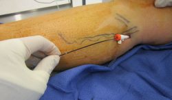 Find a vein clinic which has the best Varicose Vein Surgeon!