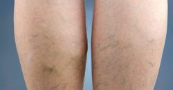 Spider vein treatment Chicago