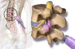 What is the process of a facet joint injection?