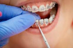 HOW CAN YOU FIND AN ORTHODONTIST NEARBY?
