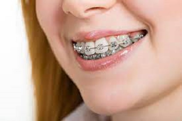 HOW TO FIND BRACES ORTHODONTIST NEAR ME