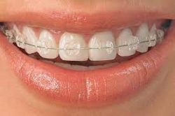 METAL BRACES AND CERAMIC BRACES