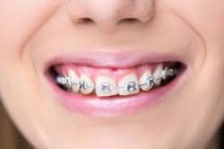 WHAT HAPPENS WHEN YOU GET BRACES