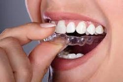 WHAT PAYMENT OPTIONS ARE AVAILABLE FOR BRACES?