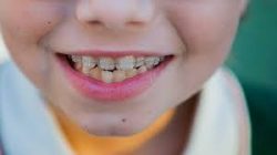 WHAT YOU SHOULD KNOW ABOUT A CHILDREN’S ORTHODONTIST NEAR ME