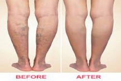 Endovenous Laser Treatment