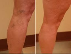 Schedule Spider Vein Removal Today