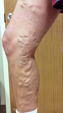 American Board of Venous Medicine (ABVLM)