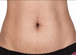 Stretch Marks Treatment Cost in Delhi