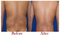 Best Liposuction Surgeon in Delhi | Dr. Vivek Kumar