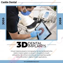 3d digital dental implants services – Cadde Dental