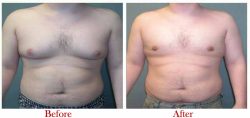 Best Gynecomastia Surgeon in Delhi | Dr. Vivek Kumar