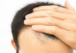 Best Doctor for Hair Treatment in Delhi