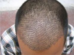 Hair Transplant Treatment Clinic in Delhi