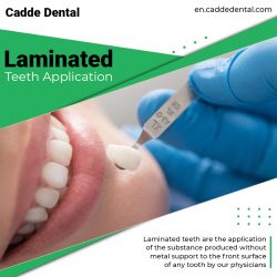 Laminated Teeth Application – Cadde Dental