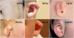 Microtia in Mumbai India | Microtia Ear