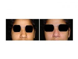 Best Nose Surgery Cost in Delhi | Dr. Vivek Kumar