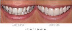 WHAT CAN DENTAL BONDING DO FOR ME?