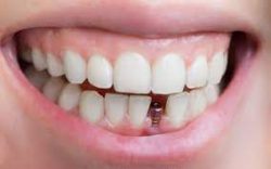 Dental implant surgery