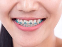Which Ones Are the Best for White Teeth?