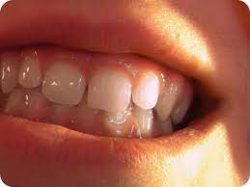 WHAT IS TEETH OVERBITE?