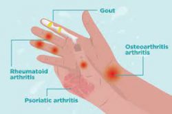 What Is Arthritis? – Arthritis Foundation